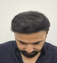 Abhinav after hair transplant