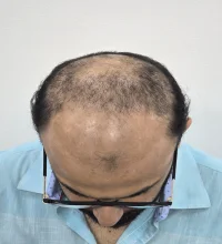 Abhinav before hair transplant