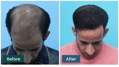 Male Hair Transplant