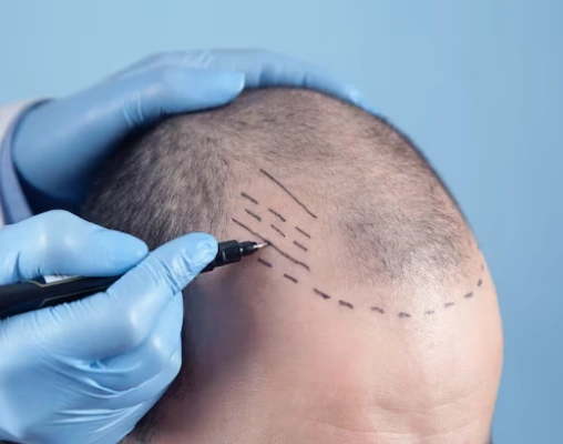 Hairline Reconstruction in Delhi