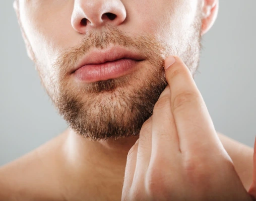 Moustache Hair Transplant in Delhi