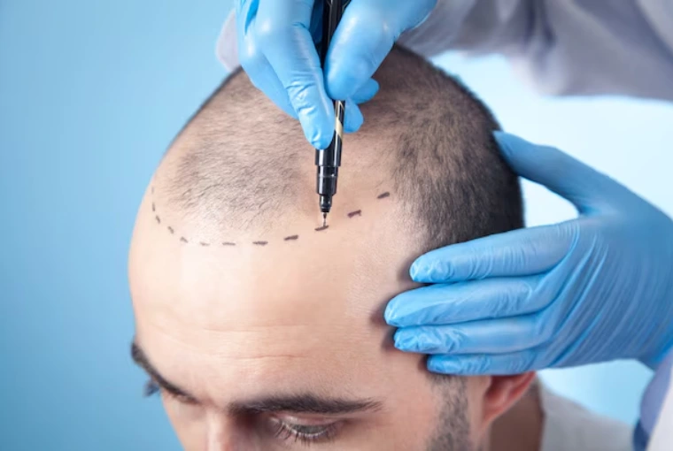FUE Hair Transplant in Delhi