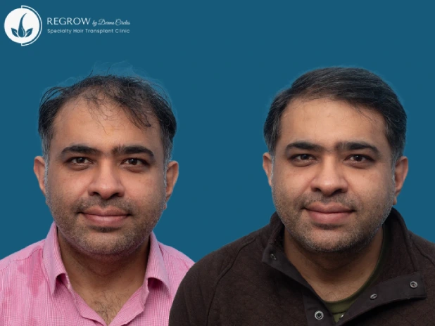 Male Hair Transplant