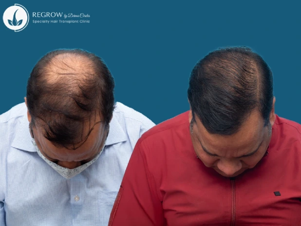 Male Hair Transplant