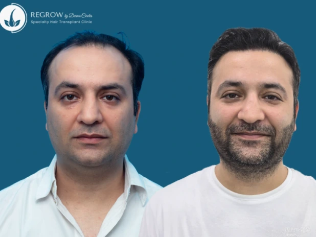 Male Hair Transplant