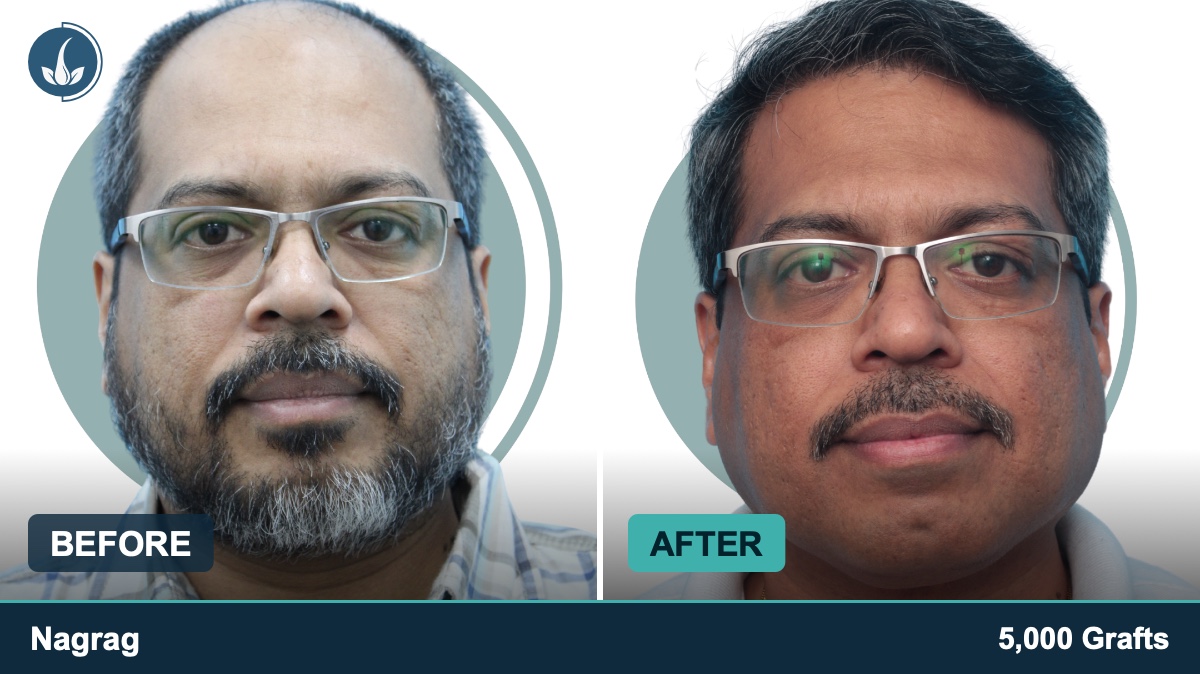 Hair transplant before and after — Regrow by Derma Circles