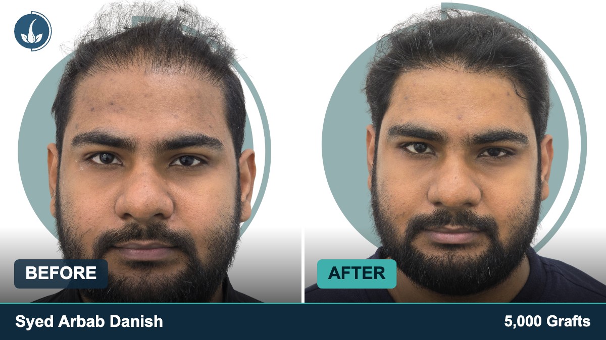 Hair transplant before and after — Regrow by Derma Circles