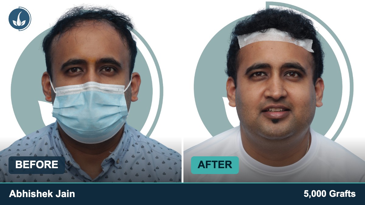Hair transplant before and after — Regrow by Derma Circles