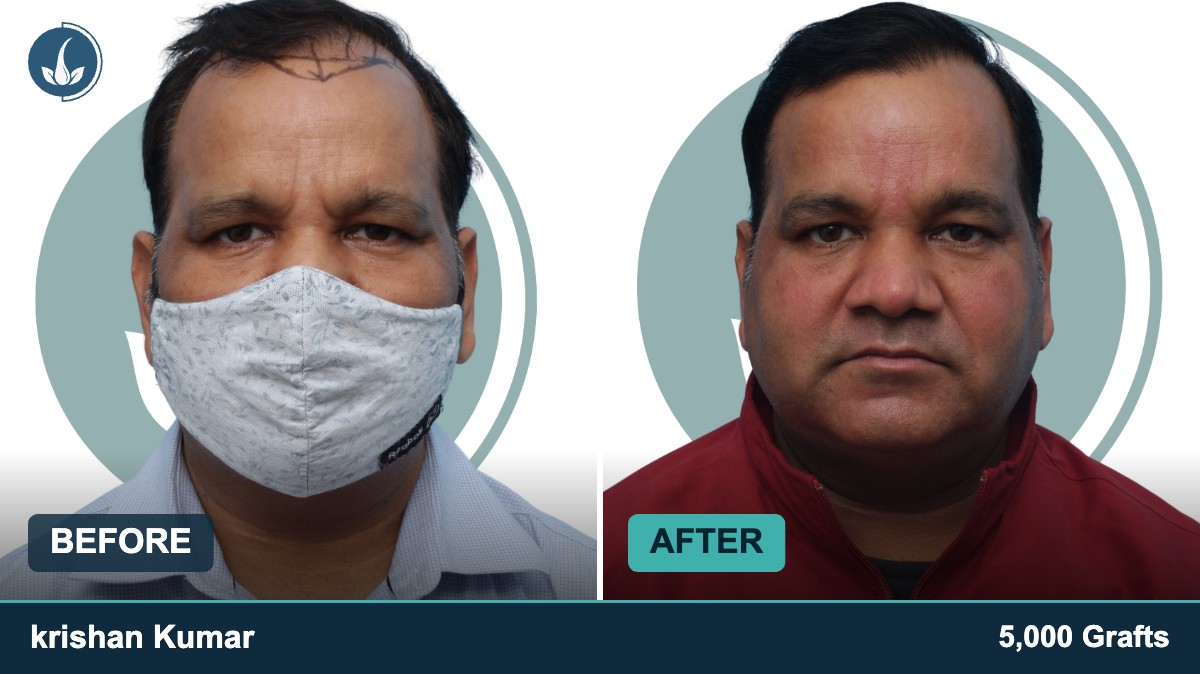 Hair transplant before and after — Regrow by Derma Circles