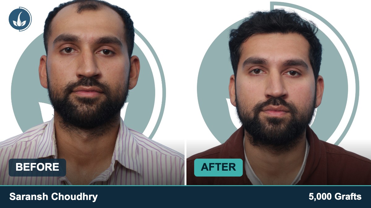 Hair transplant before and after — Regrow by Derma Circles