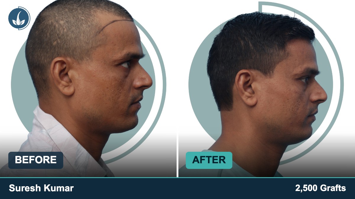 Hair transplant before and after — Regrow by Derma Circles